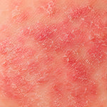 Dermatitas